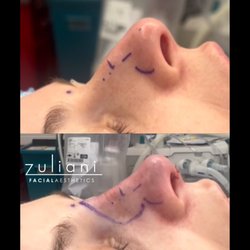 Zuliani Facial Aesthetics - On-table, immediate, rhinoplasty results.