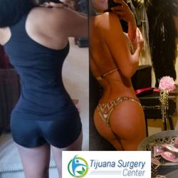 Tijuana Surgery Center - Liposuction and buttock implants. Excelents results