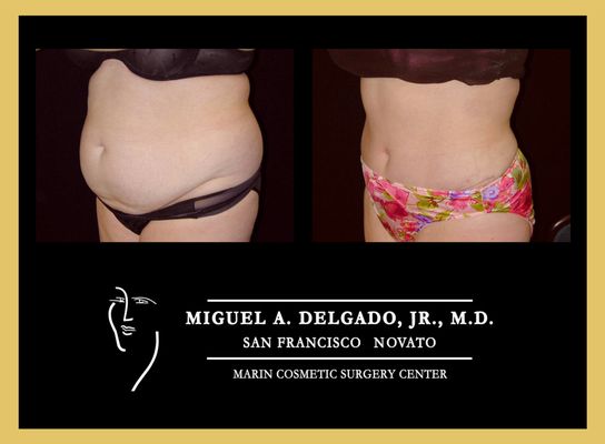 Mommy makeover - Mommy makeover surgery is a combination of cosmetic procedures that are specifically designed to address the changes that occur in a woman's body after pregnancy. This typically includes a combination of breast augmentation or lift, tummy tuck, and liposuction. By targeting these areas, mommy makeover surgery can help restore a woman's confidence and help her feel like herself again.

The benefits of mommy makeover surgery
The benefits of mommy makeover surgery are numerous and can have a positive impact on a woman's physical and emotional well-being. One of the most significant benefits is the restoration of a woman's pre-pregnancy figure. The breasts often lose volume and sag after breastfeeding, and the abdominal muscles can become stretched and loose. Mommy makeover surgery can address these issues and give a woman back her youthful and toned appearance.

In addition to the physical benefits, mommy makeover surgery can also have a profound impact on a woman's self-confidence and self-esteem. Many women struggle with body image issues after having children, and mommy makeover surgery can help them feel more comfortable and confident in their own skin. This newfound confidence can extend into all areas of a woman's life, including her relationships, career, and overall happiness.
During the initial stages of recovery, it is important to take it easy and allow your body to heal. This may mean taking time off work, avoiding strenuous activities, and getting plenty of rest. Your surgeon will let you know when it is safe to resume normal activities.
Dr. Delgado: A leader in mommy makeover surgery
Dr. Delgado is renowned for his expertise in mommy makeover surgery. With over 20 years of experience, he has helped countless women achieve their desired results and regain their confidence. Dr. Delgado understands the unique challenges that mothers face and is dedicated to providing compassionate and personalized care.