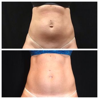 Old City Medspa - Body Contouring, Fat Reduction, Cellulite Treatment - Medical Spas Near Me - Knoxville, Tennessee Old City Medspa - Body Contouring, Fat Reduction, Cellulite Treatment - Medical Spas Near Me - Knoxville, Tennessee
