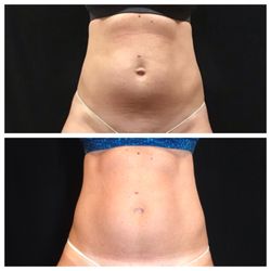 Old City Medspa - Body Contouring, Fat Reduction, Cellulite Treatment