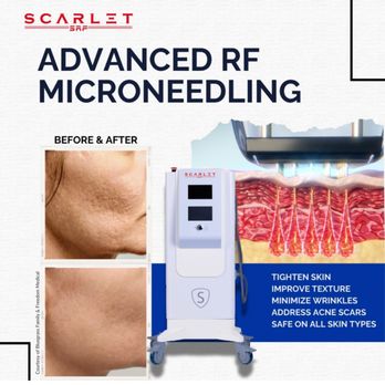 Exotica Skin Care - SCARLET SRF microneedling - Waxing Near Me - Henderson, Nevada Exotica Skin Care - SCARLET SRF microneedling - Waxing Near Me - Henderson, Nevada
