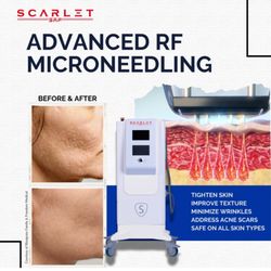 Exotica Skin Care - SCARLET SRF microneedling