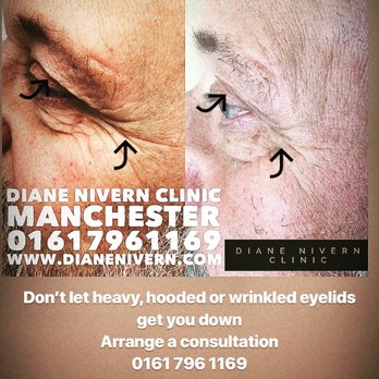 Diane Nivern Clinic - Plasma non surgical eyelid lifting to reduce wrinkled eyelids, eye bags & crow's feet. Treatments for men & women - Medical Spas Near Me - Whitefield, XGM Diane Nivern Clinic - Plasma non surgical eyelid lifting to reduce wrinkled eyelids, eye bags & crow's feet. Treatments for men & women - Medical Spas Near Me - Whitefield, XGM