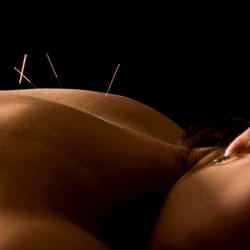 Crossings Healing and Wellness - Acupuncture for relaxation