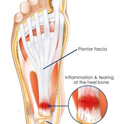 Happy Feet Plus - Example of plantar fasciitis