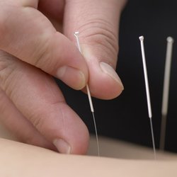 Linda McManus Acupuncture - Acupuncture has a remarkable ability to stimulate the body's own healing responses.