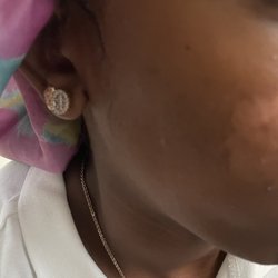 Heavenly Spa & Salon - Her cheek with the burned skin.
