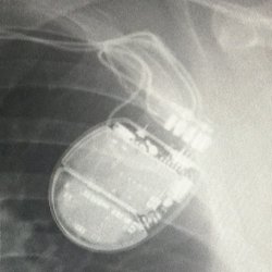 Kaweah Health - Exeter - After defibrillator implant