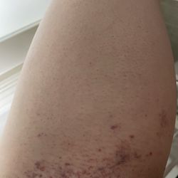 Rathfarnham Beauty Clinic - Wax of my bikini line and upper leg