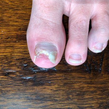 Bella Nails - Fungus I was infected with during my last pedicure that caused both my big toenails to fall off. - Nail Salons Near Me - San Mateo, California Bella Nails - Fungus I was infected with during my last pedicure that caused both my big toenails to fall off. - Nail Salons Near Me - San Mateo, California