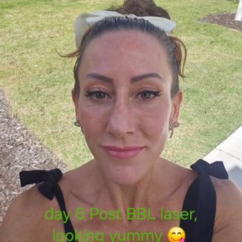 Refresh MedSpa - Day 6 BBL laser - Medical Spas Near Me - Cape Coral, Florida
