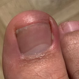 Infection starting... puss under the skin. (Right Foot)