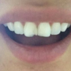 Hurontario Dundas Dental Centre - Second time filling has fallen out within a week.