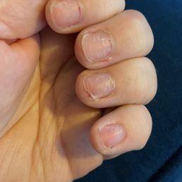 Nails destroyed from the improper care of nails and fungus
