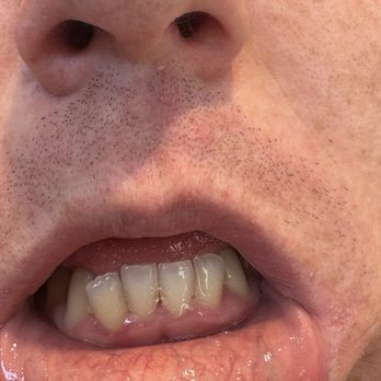 Dentique - After shot!! So nice! - Cosmetic Dentists Near Me - San Diego, California Dentique - After shot!! So nice! - Cosmetic Dentists Near Me - San Diego, California