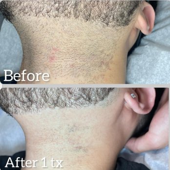 Fayz Aesthetics - Laser Hair Removal Near Me - New Windsor, New York