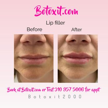 Botox It - Lip filler - Cosmetic Surgeons Near Me - Tustin, California