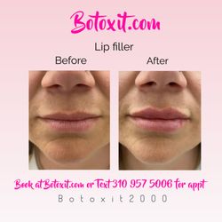 Botox It - Lip filler