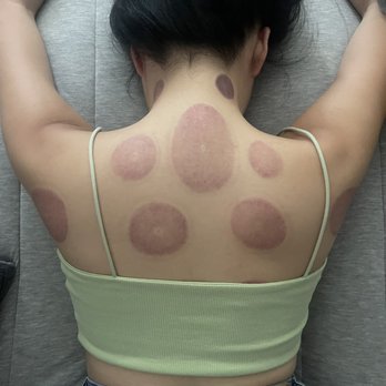 Thai Luxury Reflexology - Cupping for upper body - Reflexology Near Me - Mesa, Arizona Thai Luxury Reflexology - Cupping for upper body - Reflexology Near Me - Mesa, Arizona