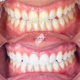 Teeth whitening Teeth whitening