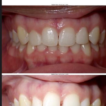 Townsend Dental Practice - Before and after Invisalign/ bonding - Pediatric Dentists Near Me - Bronx, New York Townsend Dental Practice - Before and after Invisalign/ bonding - Pediatric Dentists Near Me - Bronx, New York
