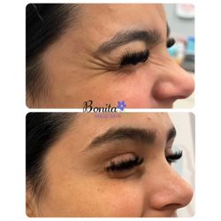 Bonita Med Spa - Crows feet