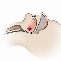 Sleep Management Institute - Sleep Apnea is caused when your throat closes during sleep and causes you to stop breathing.