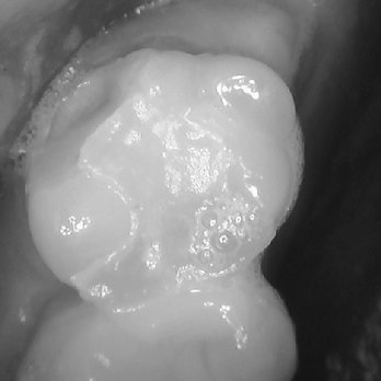 Pinnacle Dental Group - Note the big divot on the back of the tooth. - General Dentistry Near Me - Santa Ana, California Pinnacle Dental Group - Note the big divot on the back of the tooth. - General Dentistry Near Me - Santa Ana, California