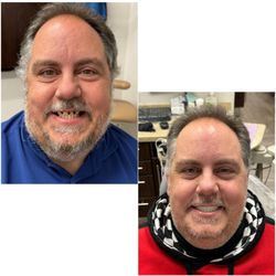 Oak Tree Dentistry - Lodi - All on 4 implants fixed teeth