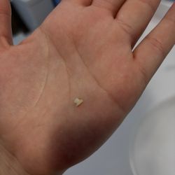 Omni Endodontics - chipped tooth