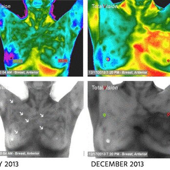 CT Thermography - Detecting early signs of breast cancer without radiation - Health & Medical Near Me - Farmington, Connecticut CT Thermography - Detecting early signs of breast cancer without radiation - Health & Medical Near Me - Farmington, Connecticut