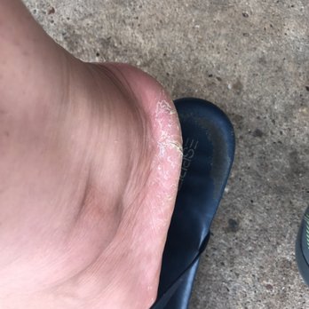Hollywood Nail And Spa - This is right after a pedicure - Nail Salons Near Me - Brookhaven, Pennsylvania Hollywood Nail And Spa - This is right after a pedicure - Nail Salons Near Me - Brookhaven, Pennsylvania