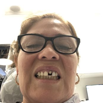 The Dental Standard - Before - Cosmetic Dentists Near Me - Chicago, Illinois