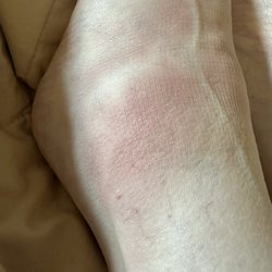 Exer Urgent Care - Canyon Country - My injury