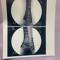Lawrence A Feiwell, MD - Doctors wonderful job!