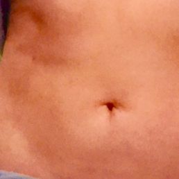 Postpartum smart lipo results from First State Vein and Laser.