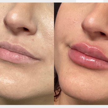 Be You Medical - Lip filler before and after - Medical Spas Near Me - Alamo, California Be You Medical - Lip filler before and after - Medical Spas Near Me - Alamo, California