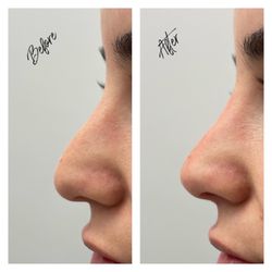 Me Myself and I Medical Spa - Nose filler asa liquid nose job aka nonsurgical nose job