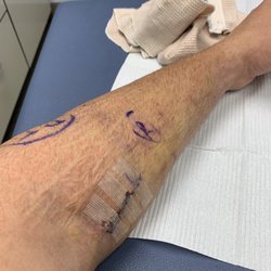 Hudson Pro Orthopaedics & Sports Medicine - 6 days post surgery and cleared to return to work like this.  Dr. Issac is terrible