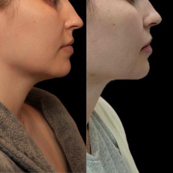 Walter J Joseph, MD - Submental (under chin) and jowl liposuction with Renuvion skin tightening - Plastic Surgeons Near Me - Beverly Hills, California Walter J Joseph, MD - Submental (under chin) and jowl liposuction with Renuvion skin tightening - Plastic Surgeons Near Me - Beverly Hills, California