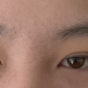 YokoMD - day 5 no makeup - Medical Spas Near Me - Pasadena, California YokoMD - day 5 no makeup - Medical Spas Near Me - Pasadena, California