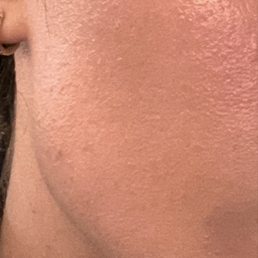 After a few pricey treatments here, no real improvement. Do your research before trusting your skin to just anyone.