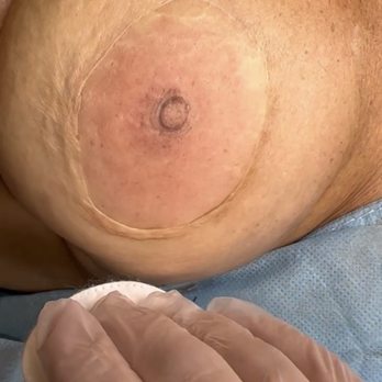 AESTHX - 3D Areola restoration by Jazz - Skin Care Near Me - Aiea, Hawaii