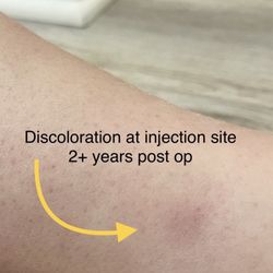 Chicago Vein Institute - They didn't have any answers or solutions when I asked them about it.