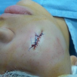 Pedro Steven D MD - Poor external sutures and not even carried all the way across