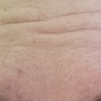 Peachy - Exactly 2 months after my 3rd treatment at Peachy MW. - Skin Care Near Me - New York, New York Peachy - Exactly 2 months after my 3rd treatment at Peachy MW. - Skin Care Near Me - New York, New York