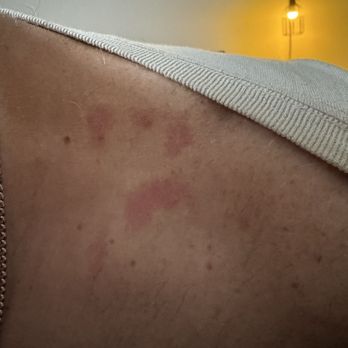 Villa Nails Bar - Burn on husband from neck wrap being too hot. - Nail Salons Near Me - Melissa, Texas