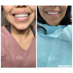 Santa Ana Orthodontics - My smile transformation!