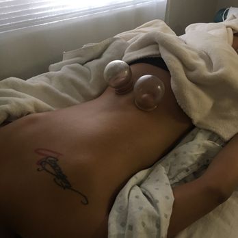 WZ Clinic - Lumbar and sciatica relief through cupping and acupuncture. - Acupuncture Near Me - Redwood City, California WZ Clinic - Lumbar and sciatica relief through cupping and acupuncture. - Acupuncture Near Me - Redwood City, California
